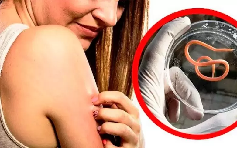 зуд и раздражение из-за паразитов в организме