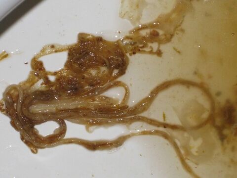 паразитические черви из организма человека